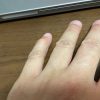 指の腫れ 第一関節 へバーデン結節