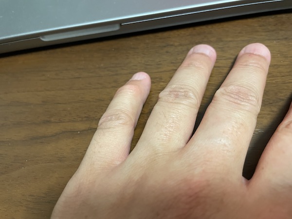 指の腫れ 第一関節 へバーデン結節