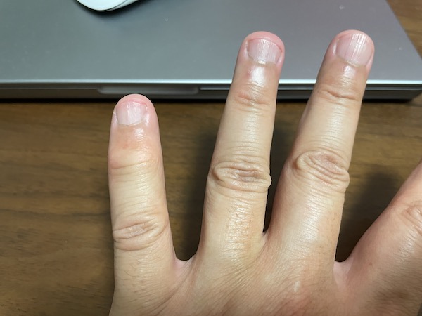 へバーデン結節 指の腫れ